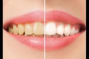 牙齿美白后还会变黄吗 牙齿美白后注意事项有哪些