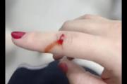 蹭破皮怎么止血最快/蹭破止血最简单的方法
